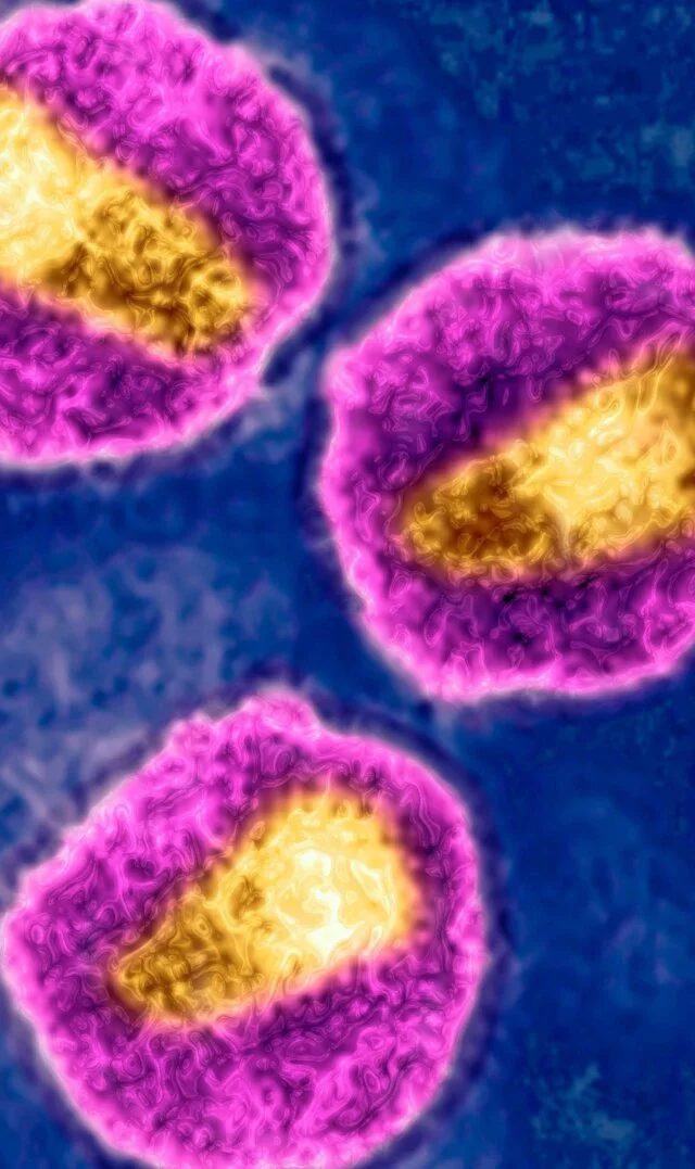 Norveçdə Qardaşın Köməyilə HIV-dən Xilas Olan Adam