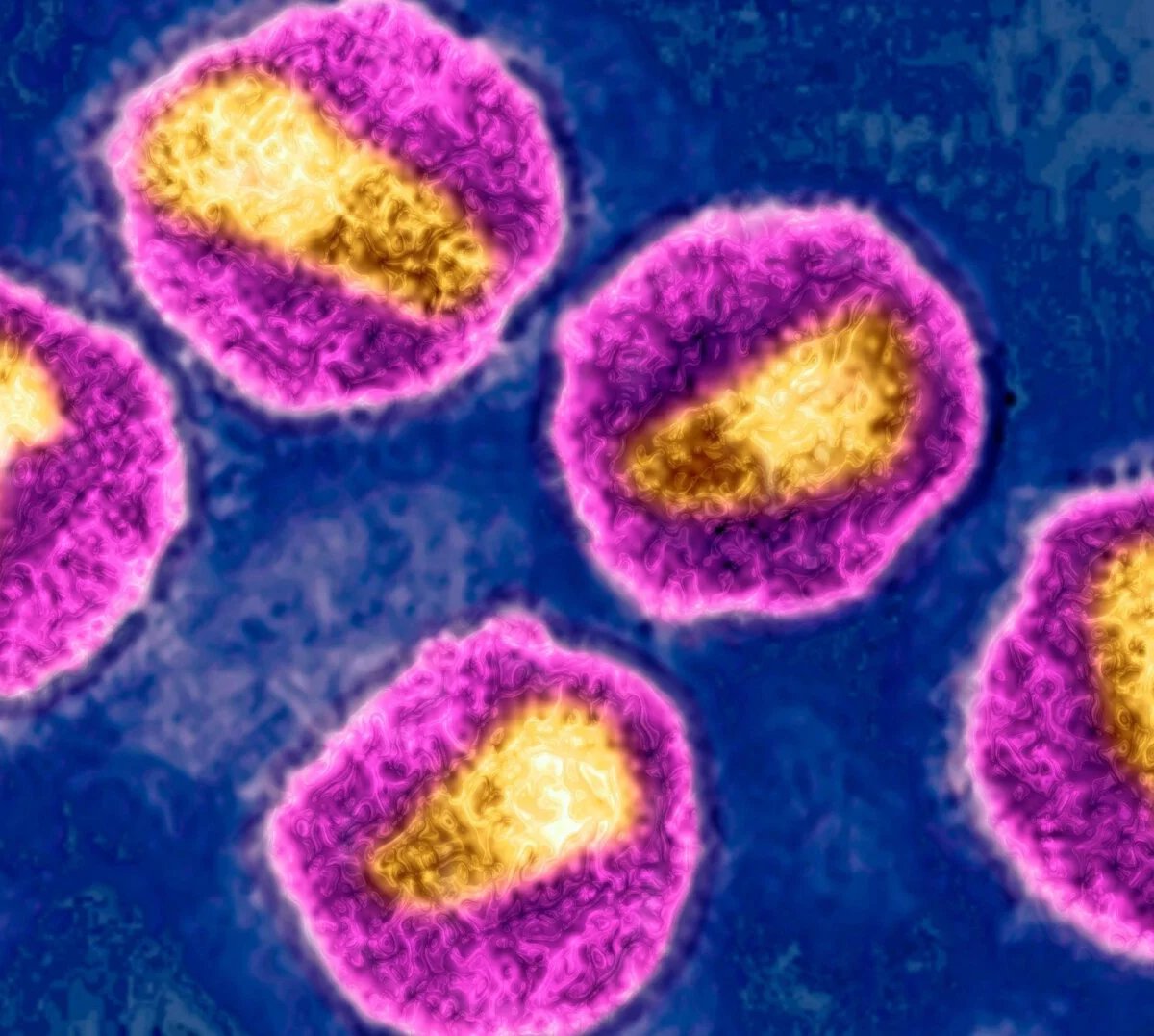 Norveçdə Qardaşın Köməyilə HIV-dən Xilas Olan Adam