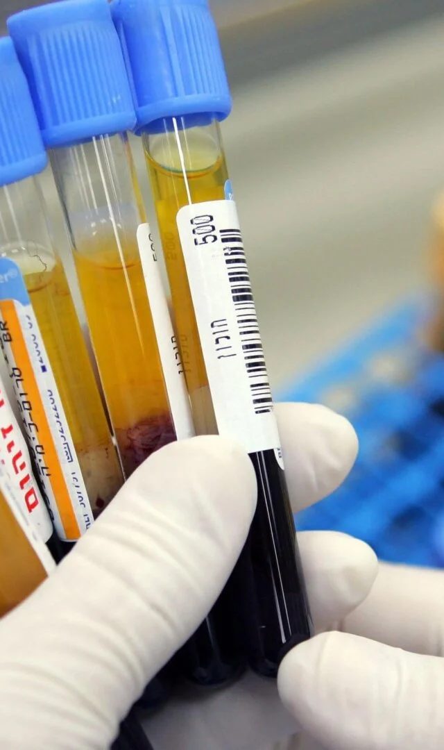 Sadə Qan Testi Demensiyanı 25 İl Əvvəl Proqnozlaşdıra Bilər