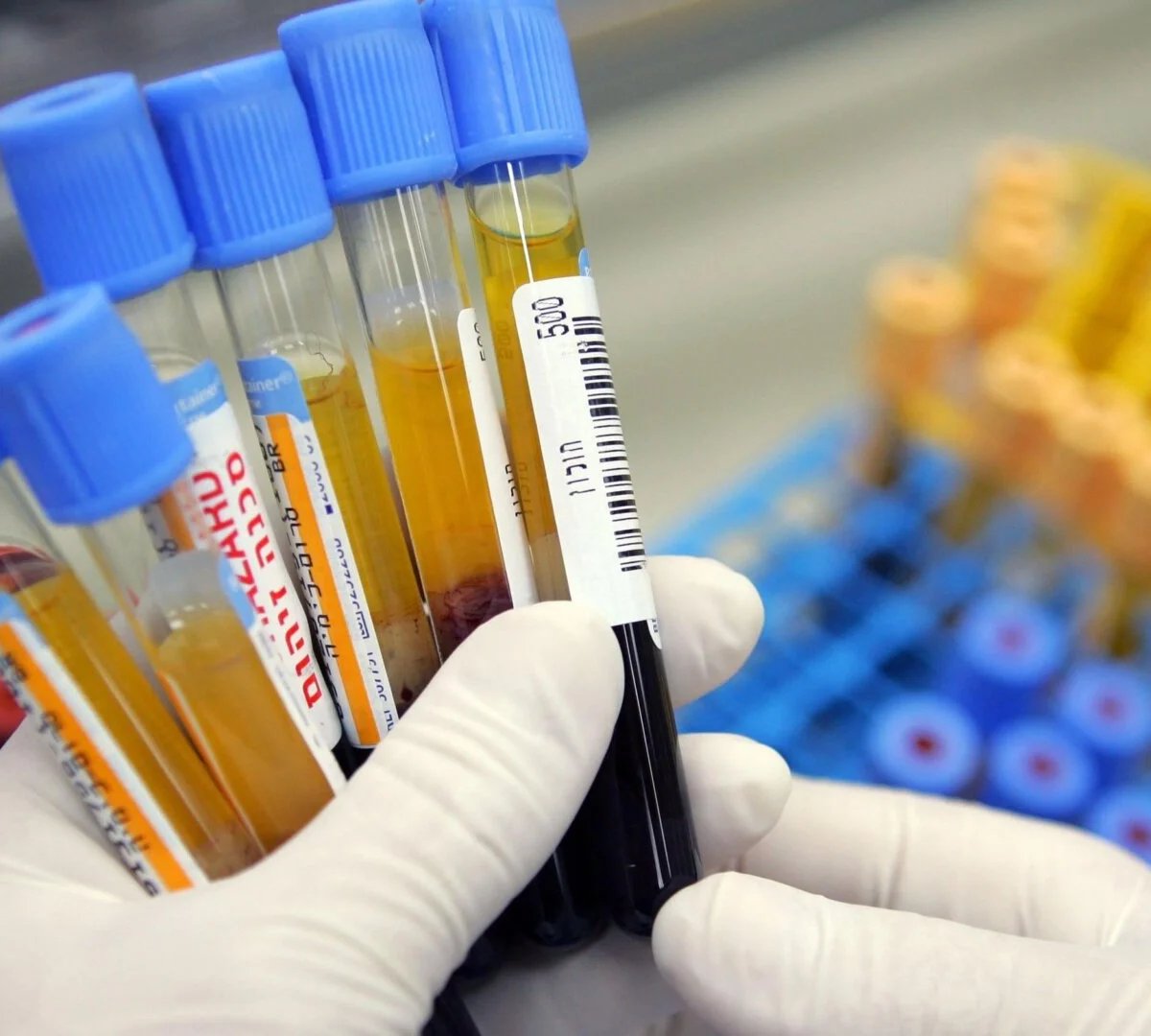 Sadə Qan Testi Demensiyanı 25 İl Əvvəl Proqnozlaşdıra Bilər